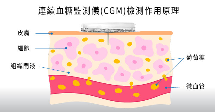 連續血糖監測儀,CGM,CGM檢測作用原理